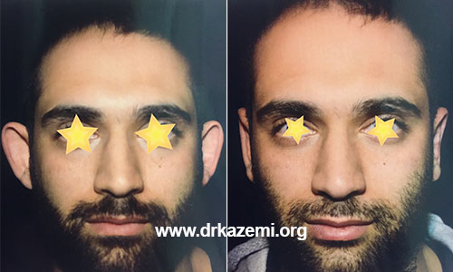 Otoplasty In Iran