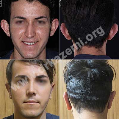 Otoplasty